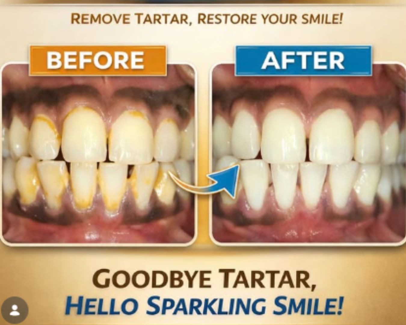 Clear aligner treatment