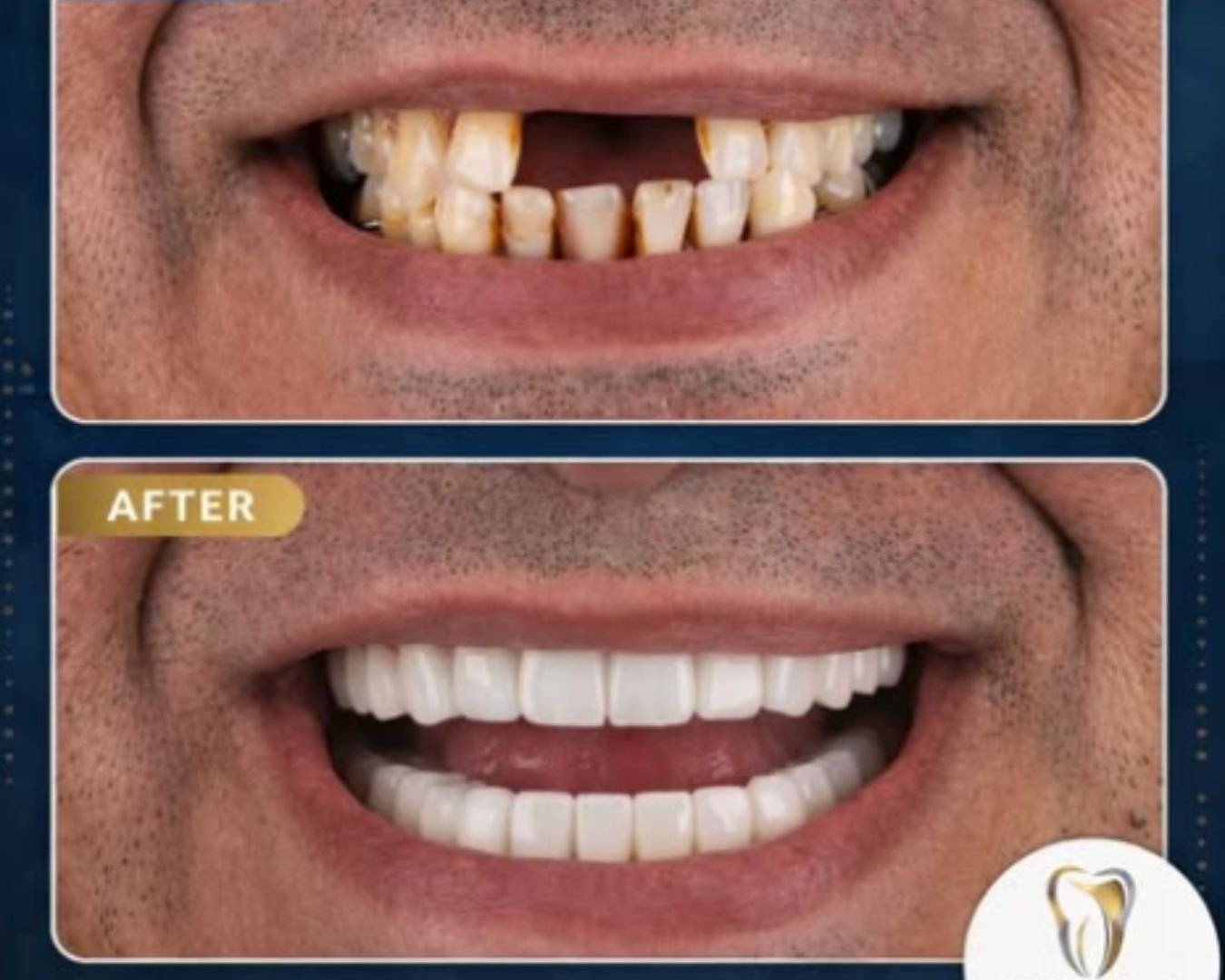 Clear retainer material
