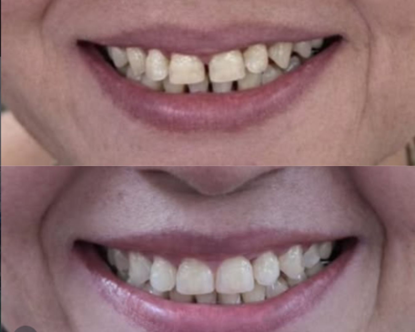 Comfortable braces smile